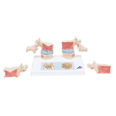Osteoporosis Model A95 4