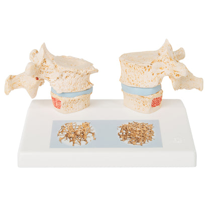Osteoporosis Model A95