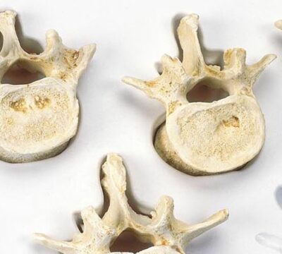 Set of 5 lumbar vertebrae A792 3