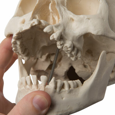 Skull with Cleft Jaw and Plate A29/3 6