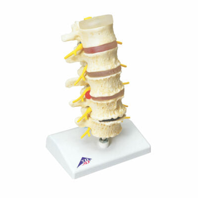 Vertebral Degen and Stages of Disc Prolapse A795 1