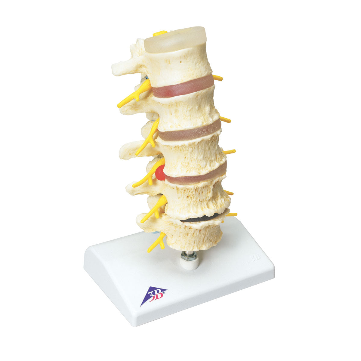 Vertebral Degen and Stages of Disc Prolapse A795