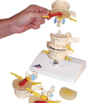 Vertebral Degen and Stages of Disc Prolapse A795 2
