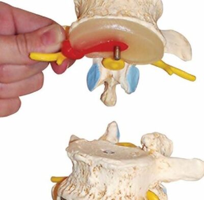 Vertebral Degen and Stages of Disc Prolapse A795 3