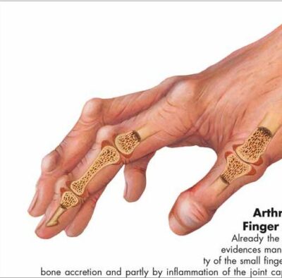 Arthritis Chart VR1123 1