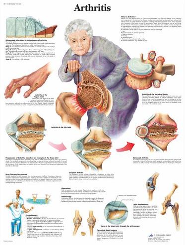 Arthritis Chart VR1123