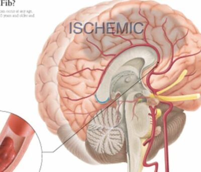 Atrial Fibrillation and Ischemic Strokes 1456 3
