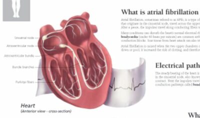 Atrial Fibrillation and Ischemic Strokes 1456 2