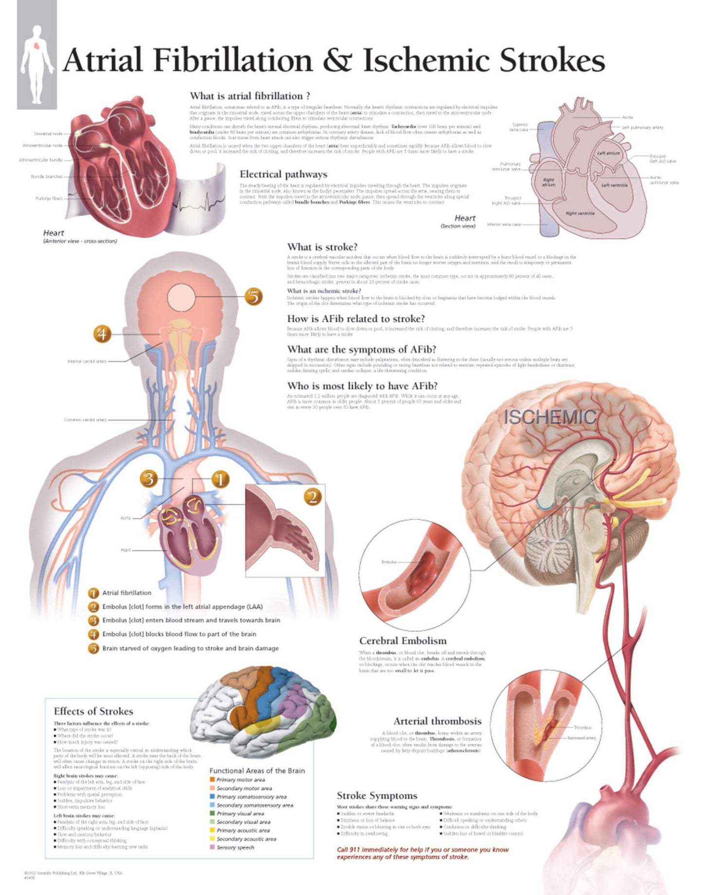 Atrial Fibrillation and Ischemic Strokes 1456