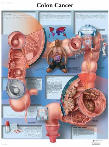 Colon Cancer Chart VR1432