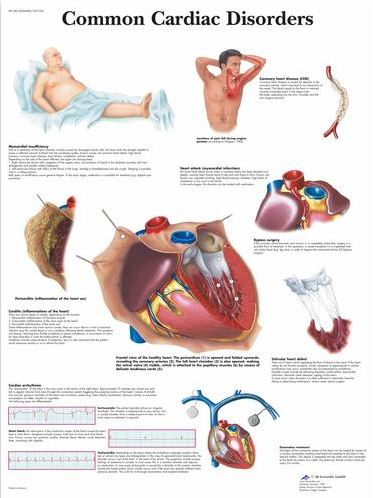 Common Cardiac Disorders Chart VR1343
