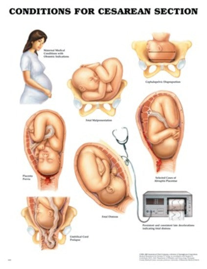 Conditions for Cesarean Section
