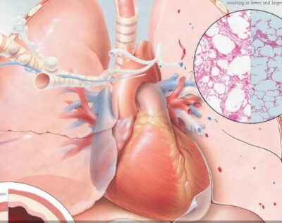 COPD 1351 3