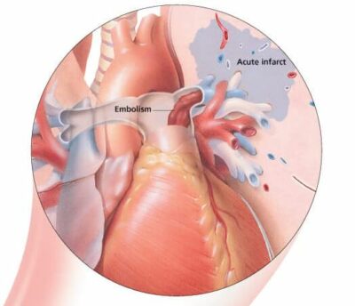 Deep Vein Thrombosis (DVT) 1652 3