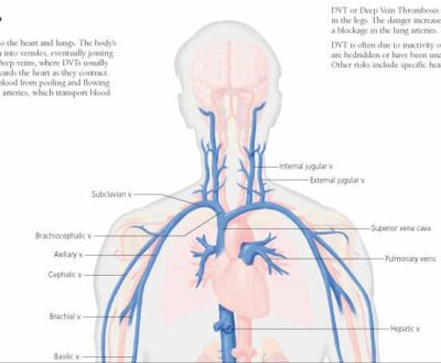 Deep Vein Thrombosis (DVT) 1652 2