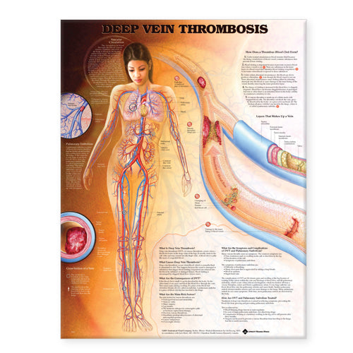 Deep Vein Thrombosis Anatomical Chart 8953