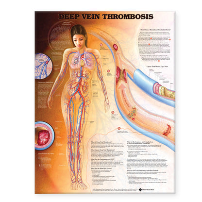 Deep Vein Thrombosis Anatomical Chart 8953