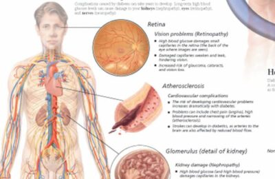 Diabetes 1650 2