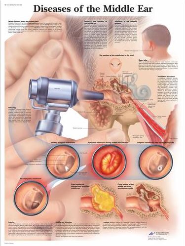 Diseases of the Middle Ear Chart VR1252