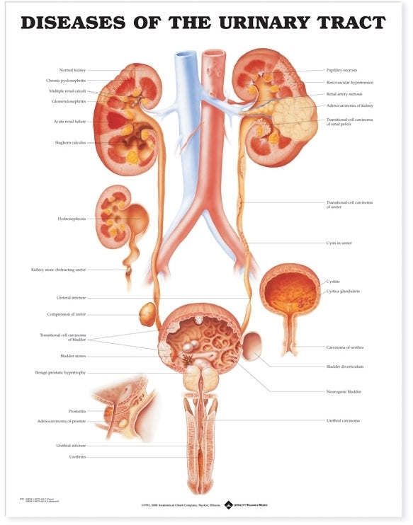 Diseases of the Urinary Tract Anatomical Chart 9797