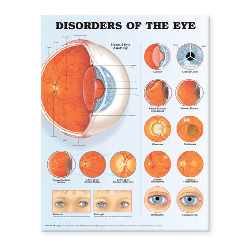 Disorders of the Eye Anatomical Chart 9695