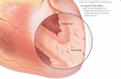 Effects of Hypertension 1451 3