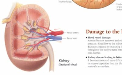 Effects of Hypertension 1451 2