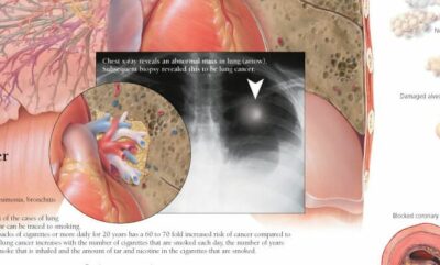 Effects of Smoking 1352 3