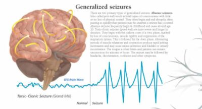 Epilepsy 1754 3