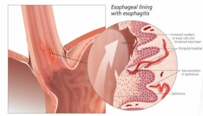 Gastroesophageal Reflux Disease (GERD) 1550 3