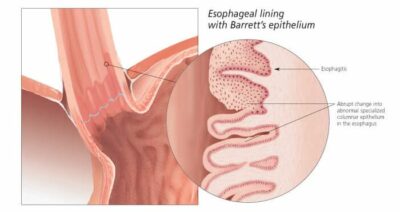 Gastroesophageal Reflux Disease (GERD) 1550 2