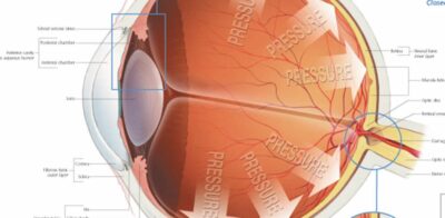 Glaucoma 2250 3