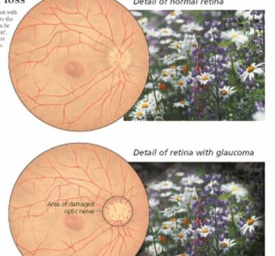 Glaucoma 2250 2