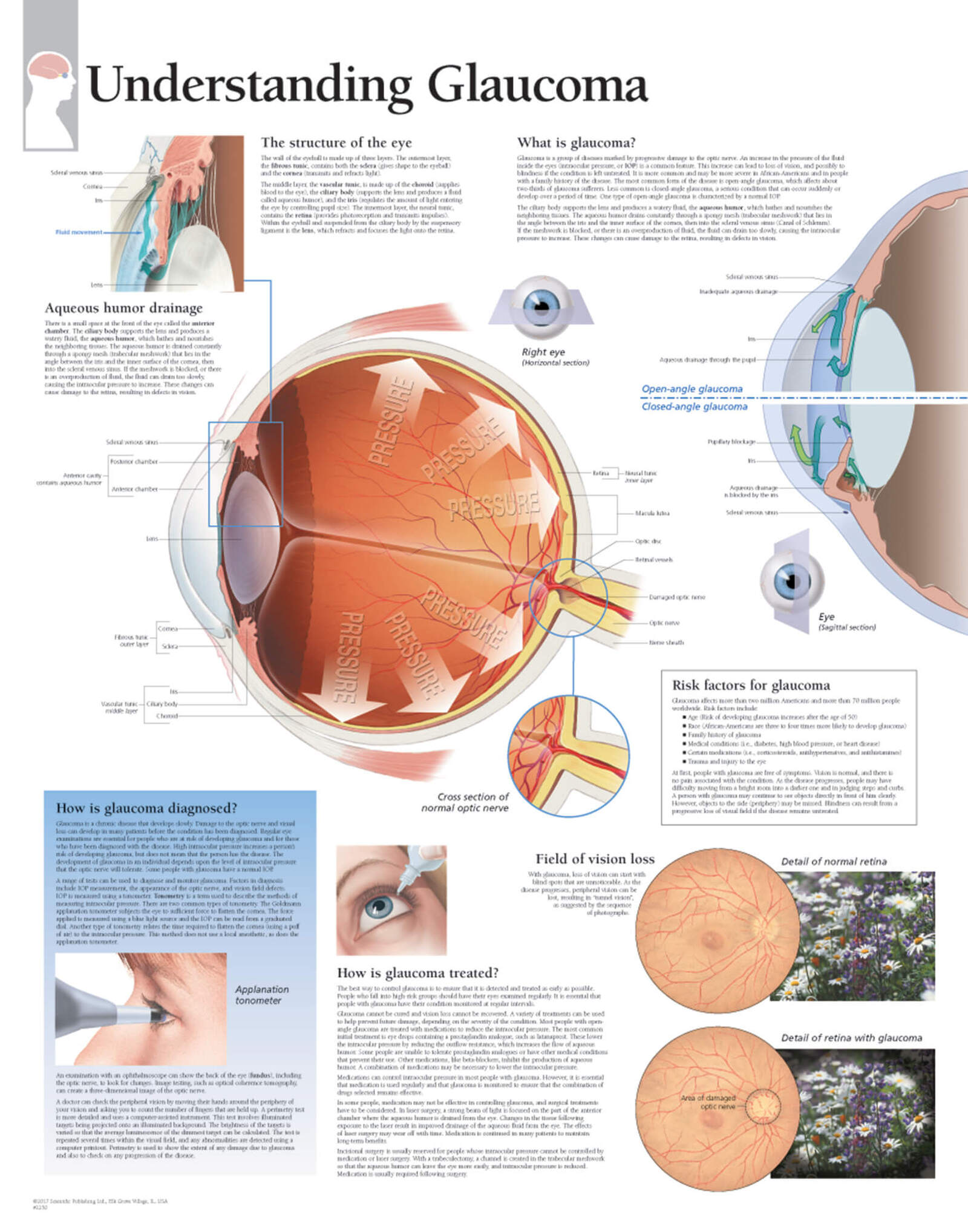 Glaucoma 2250