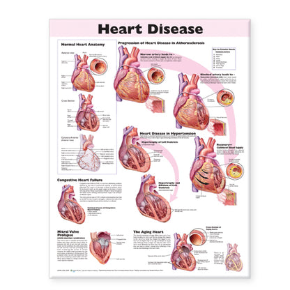 Heart Disease Anatomical Chart 9912