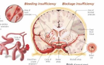 High Blood Pressure 1450 2