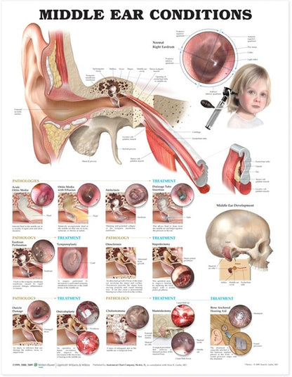 Middle Ear Conditions Anatomical Chart 9893