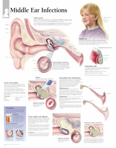 Middle Ear Infections 2150 1