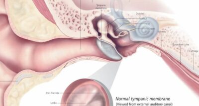 Middle Ear Infections 2150 3