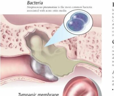 Middle Ear Infections 2150 2