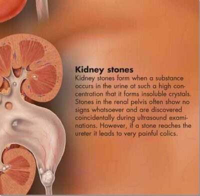 Kidney Chart VR1515 1