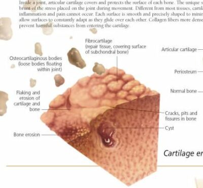 Osteoarthritis 1050 3