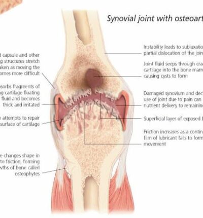 Osteoarthritis 1050 2