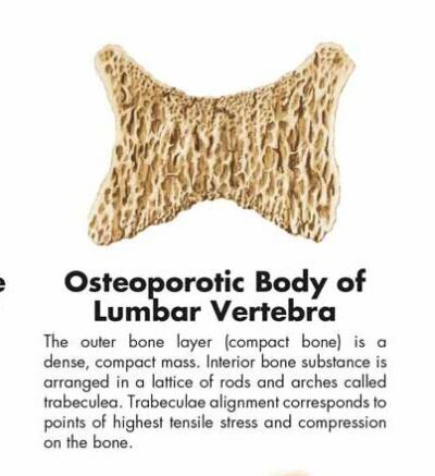 Osteoporosis Chart VR1121 2