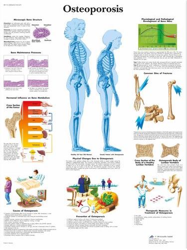 Osteoporosis Chart VR1121