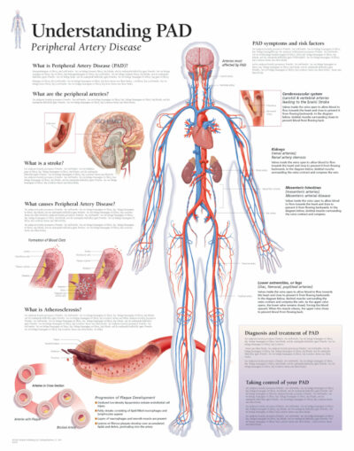 Peripheral Artery Disease (PAD) 1655 1
