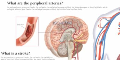 Peripheral Artery Disease (PAD) 1655 3