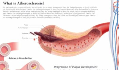 Peripheral Artery Disease (PAD) 1655 2