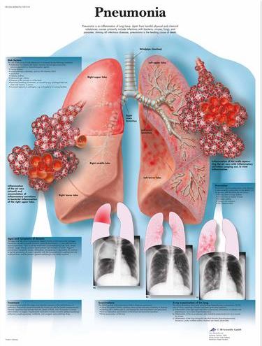 Pneumonia Chart VR1326