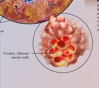 Respiratory Tract Infections Chart VR1253 1